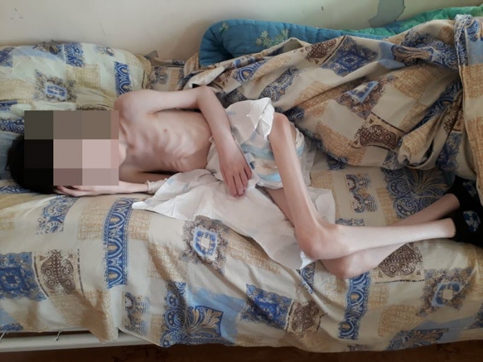 
            В Якутии 21-летнего инвалида в интернате довели до крайнего истощения        