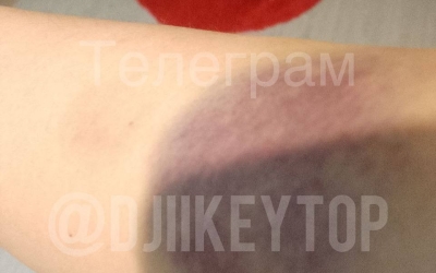 Жительница Якутска получила ушибы из-за врезавшегося в нее электросамокатчика: Горожанка просит запретить этот вид транспорта