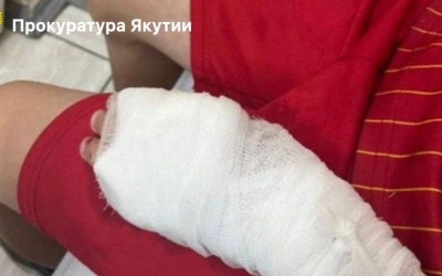 В Алдане подали иск на хозяина собаки, которая укусила малолетнего ребенка