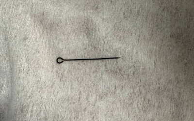 Острая боль: В Якутии женщина проглотила булавку, которая воткнулась в слизистую желудка