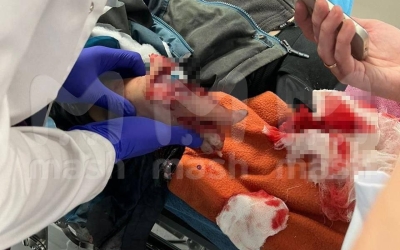 Мальчику оторвало пальцы при взрыве после попытки поднять 10-рублевую купюру