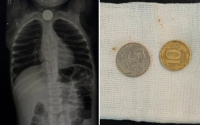 В Якутии трехлетний мальчик проглотил две монеты номиналом 5 и 10 рублей